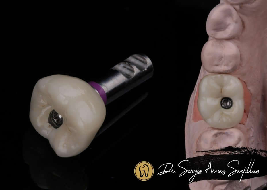Implantes-dentales-reynosa