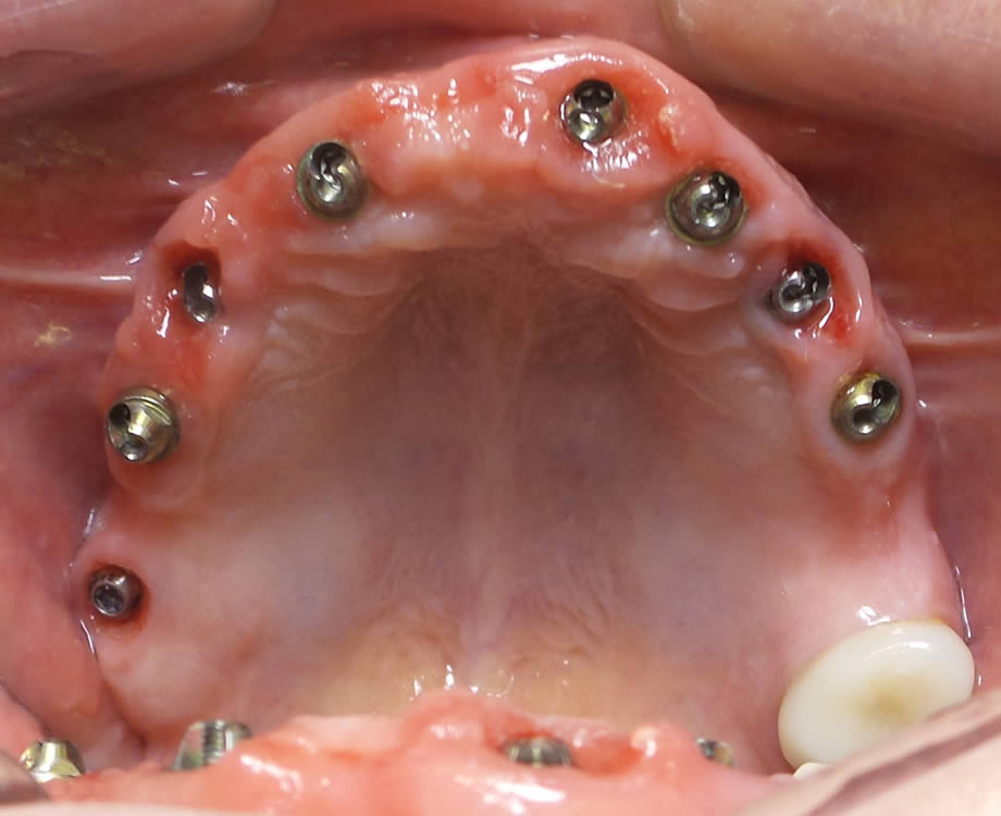 caso5-implantes-dentales-reynosa01