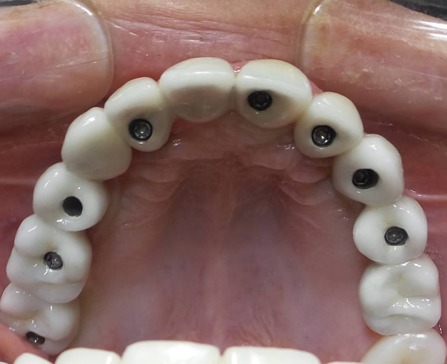 caso5-implantes-dentales-reynosa02