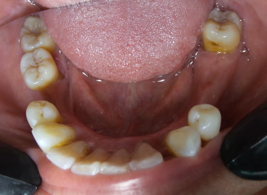 caso6-implantes-dentales-reynosa01