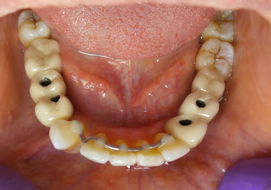 caso6-implantes-dentales-reynosa02