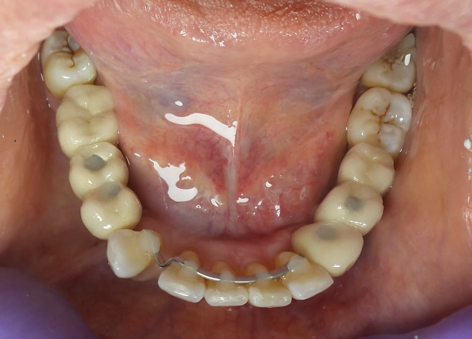 caso6-implantes-dentales-reynosa03