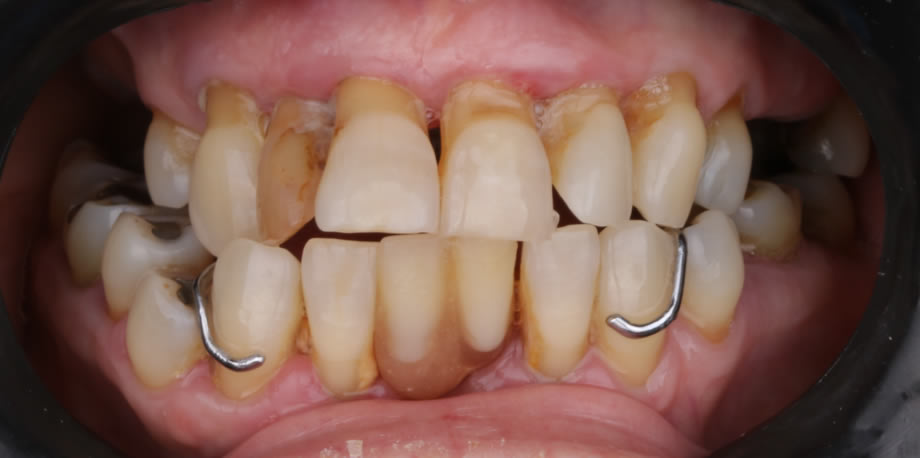 caso7-implantes-dentales-reynosa01