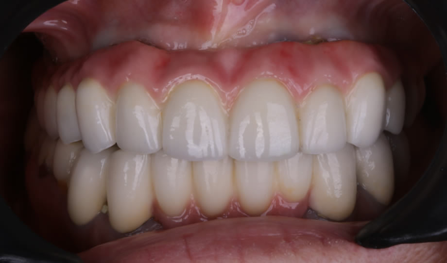 caso7-implantes-dentales-reynosa02
