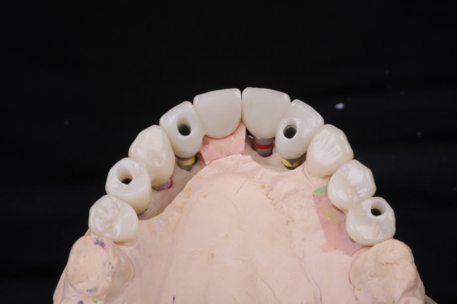 caso8-implantes-dentales-reynosa01