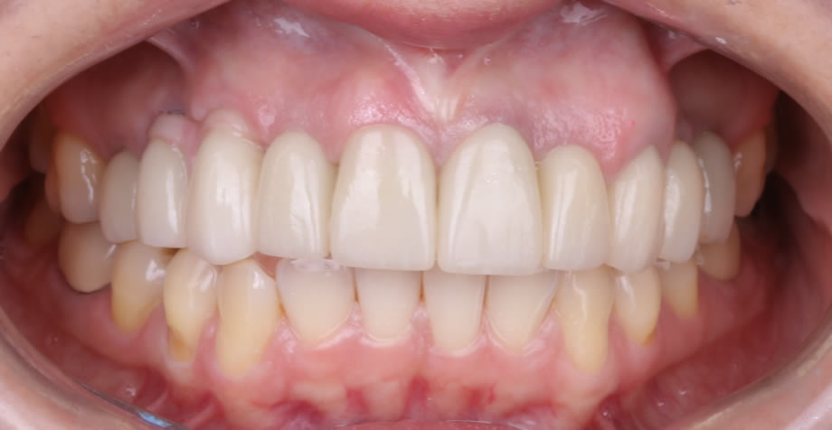 caso8-implantes-dentales-reynosa02