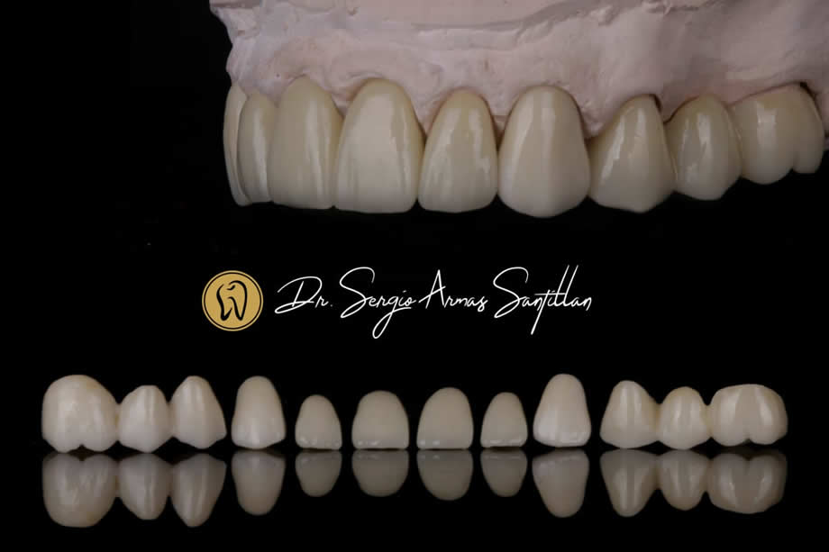 restauraciones-en-porcelana-dr-sergio-armas-implantes-dentales-colonia-del-prado-reynosa
